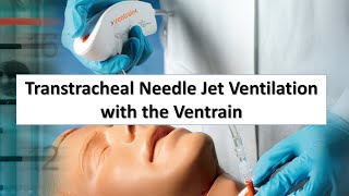 Transtracheal Needle Jet Ventilation TTJV with the Ventrain [upl. by Trutko]