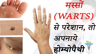 How to Remove WartsGenital Warts  BEST HOMEOPATHIC MEDICINES IN 2020 मस्से [upl. by Macilroy]