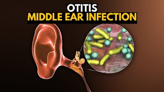 Middle Ear Infection Otitis Media Causes SIgns and Symptoms Diagnosis and Treatment [upl. by Madelle]