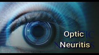 Optic Neuritis Alternative Treatment  Mind Over MS Podcast Episode 18 [upl. by Addiel]