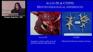 Chronic Thromboembolic Pulmonary Hypertension Deepa Gopalan MD [upl. by Cchaddie]