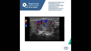 Espacio para Prof  Ecografía tiroidea con elastografía en el diag del cáncer de tiroides [upl. by Devinna]