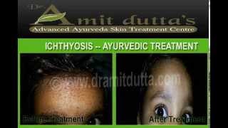 Ayurvedic Treatment for Ichthyosis Vulgaris at Jalandhar  Punjab  India Dr Amit Dutta [upl. by Tenahs]