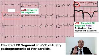 EKG Trainer Case 20 Answer [upl. by Karel]