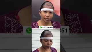 Hair Transplant Results Raipur Chhattisgarh  Hair Transplant 5 Months Result fue hair shorts cg [upl. by Alegnaed930]