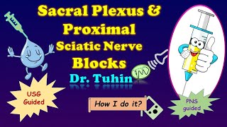 Ultrasound guided Sacral Plexus Block  Proximal Sciatic Nerve Block  Dual Guidance  USG  PNS [upl. by Esilrac]