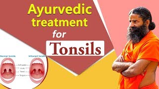 Ayurvedic Treatment for Tonsil  Swami Ramdev [upl. by Trotta366]