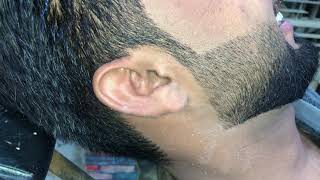 New blackhead in ear extraction Today 2024 4K [upl. by Leanard]