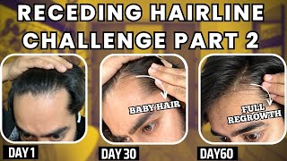 30 days HAIRLINE REGROWTH challenge PART 2  सिर्फ 1 महीने मैं RECEDING HAIRLINE REGROW करो [upl. by Cirek]