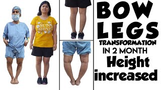 Height increased after bow legs surgery  bow legs transformation genu verum fixed [upl. by Eltsyrc]