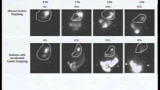 Vaciamiento gástrico e hiperglucemia postprandial  P1 [upl. by Nivrag]