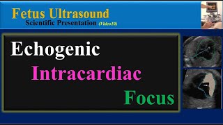 Fetal Echogenic Intracardiac Focus  Ultrasound  Anomaly  Case 261 [upl. by Nnaeirb]