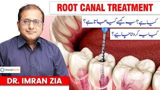 What is Root Canal Treatment  Root Canal Procedure Explained by Dr Imran Zia  Dental Guild [upl. by Ailic]