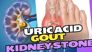 Uric Acid and its complications and lab test  Uric Acid Kidney stones [upl. by Ahsinut891]