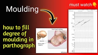 Moulding  Fetal head moulding  labour process easy explanation in hindi  Nursing guidance [upl. by Bred]