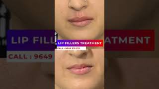 The Best Lips Fillers Treatment at skinaa clinic  Viral shorts [upl. by Meredi57]