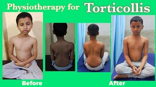 Torticollis Physiotherapy treatmentWry Neck Exercises Torticollis stretching exercises [upl. by Jp]