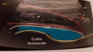 INFILTRAZIONE COXOFEMORALE in ecoguida [upl. by Madid]