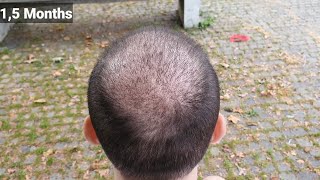 FUE Hair Transplant Timeline I Day 1 to Day 365 I Before amp After [upl. by Aitenev815]