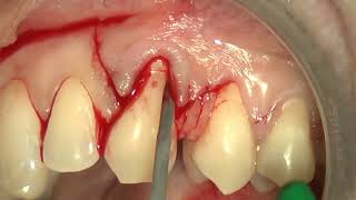 9 Multiple bilaminar technique with single vertical releasing incision in the upper jaw [upl. by Eatnom]