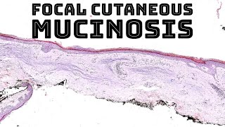 Focal cutaneous mucinosis focal dermal mucinosis pathology dermpath dermatology dermatopathology [upl. by Phina108]