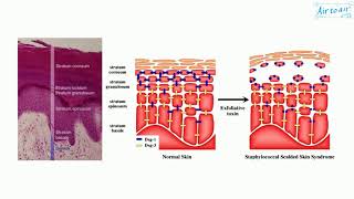 staphylococcal scalded skin syndrome [upl. by Hake]