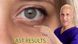 Remove Eye Bags Dark Circles Acne and Get Clear Skin Naturally Dr Mandell [upl. by Greenfield]