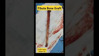 Fibula Bone Graft 🔥 फ़िबुला ग्राफ्ट fibula fibulafracture grafting bonefracture [upl. by Tabb]