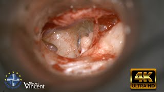 Traumatic Incus Dislocation  Total Ossicular Reconstruction  Malleus Relocation amp Silastic Banding [upl. by Meenen]