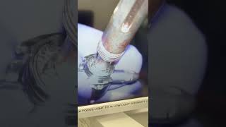 How to remove Nuvasive Reline spinal pedicle screws T27 set screw T25 pedicle screw [upl. by Reichert116]