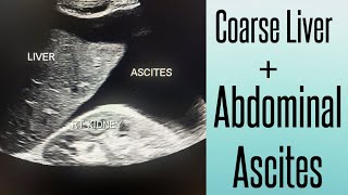 Coarse Liver amp Abdominal Ascites on Ultrasound  Chronic Liver Disease  Liver Cirrhosis [upl. by Namie]