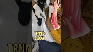 Tennis Elbow Steroid Injection  ortho elbow tenniselbow steroid injection [upl. by Liahcim]