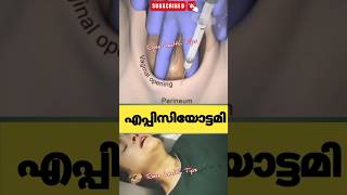 പ്രസവസമയത്ത് episiotomy ചെയ്യുന്നത്pregnancy education malayalam [upl. by Standing767]