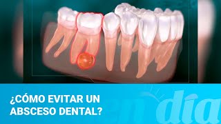 ¿Cómo evitar un absceso dental [upl. by Reginnej]