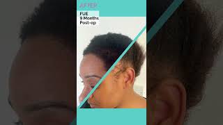 Afro Female Hair Transplant in Turkey  Longevita [upl. by Annam]