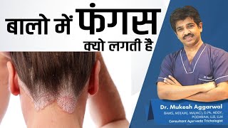 Cause amp Treatment of Fungal Infection in Hair  Dr Mukesh Aggarwal [upl. by Dobb576]