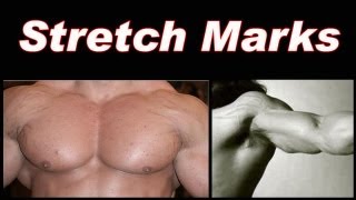 Bodybuilding Stretch Marks [upl. by Tlevesoor900]