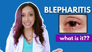 What Is Blepharitis Eye Doctor Explains [upl. by Annaira]