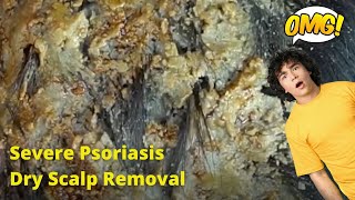 Removal of SEVERE Psoriasis Seborrheic Dermatitis Dry Scalp amsr [upl. by Haelak]