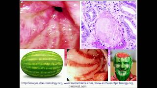 Histopathology  Gastric Antral Vascular ectasia GAVE [upl. by Bertrand]