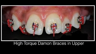 Orthodontic case presentation of Class II division 1 Damonortho education extractiondeep bite [upl. by Saref793]