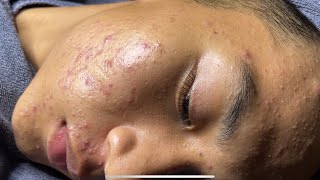 Blackheads amp Pimples Pore Removal New 2024  Acne Treatment With Bo Nguyễn Spa [upl. by Asirak691]