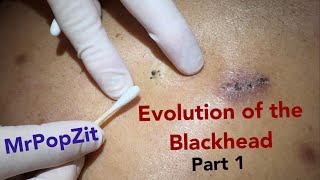 Evolution of the blackhead part 1 The rare trident blackhead Triple barrel extraction [upl. by Kcinom125]