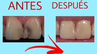 RECONSTRUCCIÓN DIENTES CON CARIES [upl. by Ayn]