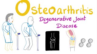 Osteoarthritis OA  Introduction  Rheumatology Series [upl. by Hansel]