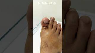 Toe Dislocation Reduction Procedure  Hindi  अंगूठे की खिसकी हुई हड्डी को कैसे बैठाया जाता है [upl. by Yrrol]