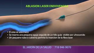 Animation of Ablación Laser Endovenosa [upl. by Lam]