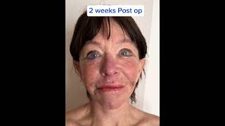 Full facelift journey with Azurite 📌 necklift facelifting faceliftsurgery surgerythailand [upl. by Babette]