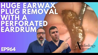 HUGE EAR WAX PLUG REMOVAL WITH A PERFORATED EARDRUM  EP964 [upl. by Deloris]