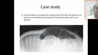 Case 84 intestinal perforation pneumoperitoneum complicated NEC free air under ther diaphragm [upl. by Genaro]